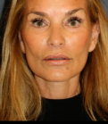 Feel Beautiful - Necklift 204 - After Photo